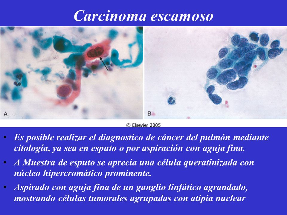 Carcinoma escamoso Es posible realizar el diagnostico de cáncer del pulmón mediante citología, ya sea en esputo o por aspiración con aguja fina.