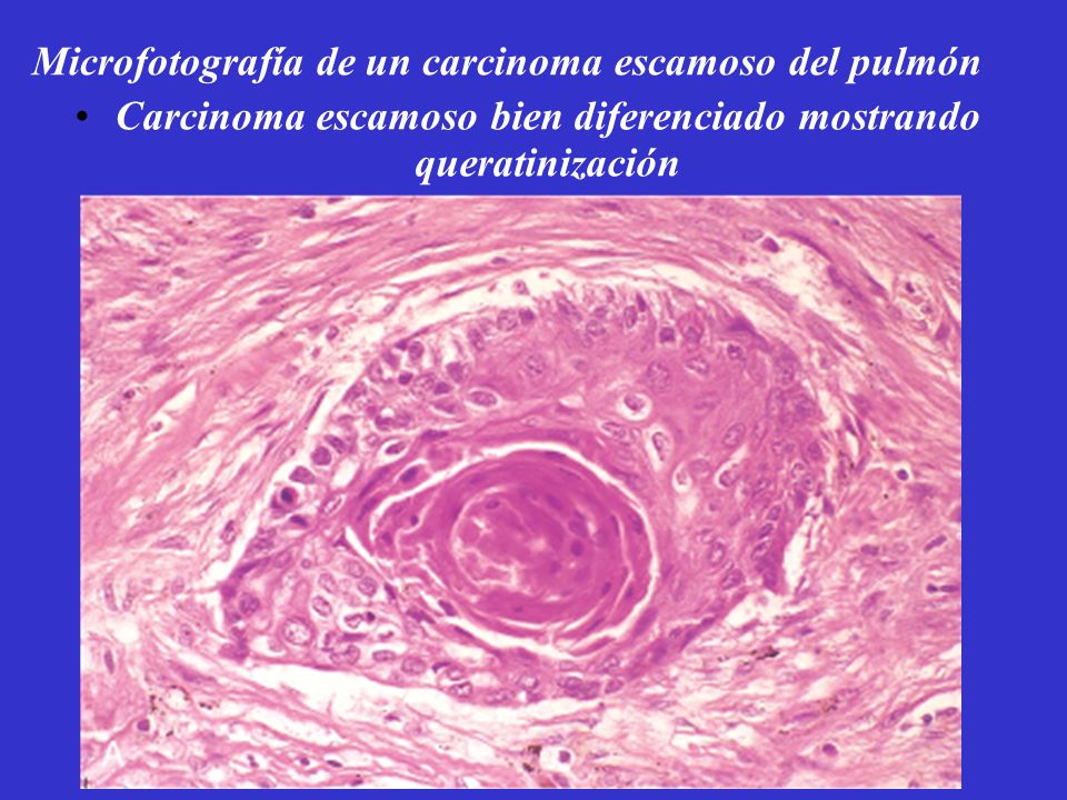 Microfotografía de un carcinoma escamoso del pulmón