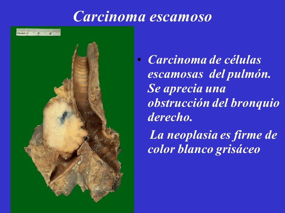 Carcinoma escamoso Carcinoma de células escamosas del pulmón. Se aprecia una obstrucción del bronquio derecho.