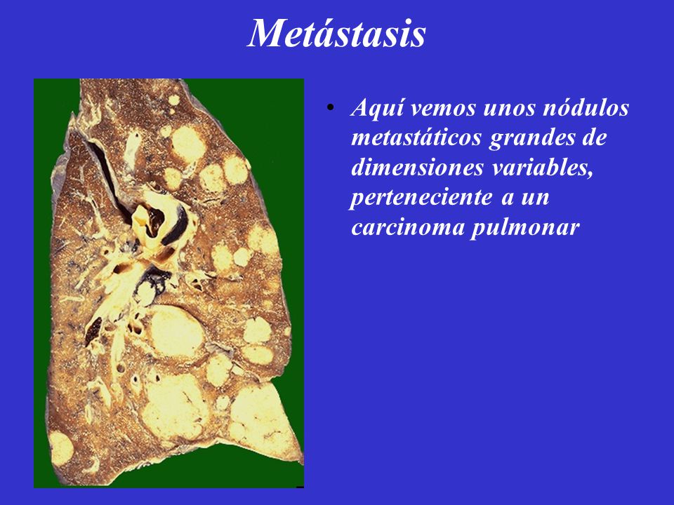 Metástasis Aquí vemos unos nódulos metastáticos grandes de dimensiones variables, perteneciente a un carcinoma pulmonar.