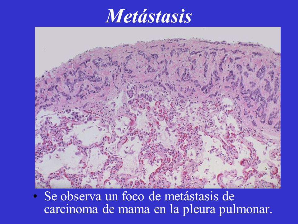 Metástasis Se observa un foco de metástasis de carcinoma de mama en la pleura pulmonar.