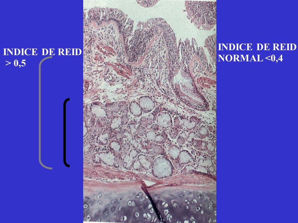 INDICE DE REID NORMAL <0,4 INDICE DE REID > 0,5