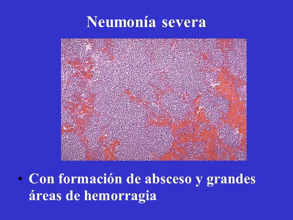 Neumonía severa Con formación de absceso y grandes áreas de hemorragia