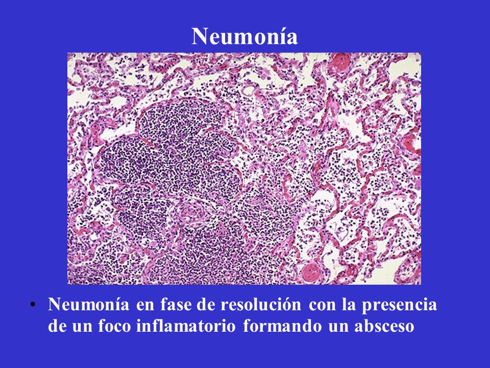 Neumonía Neumonía en fase de resolución con la presencia de un foco inflamatorio formando un absceso.