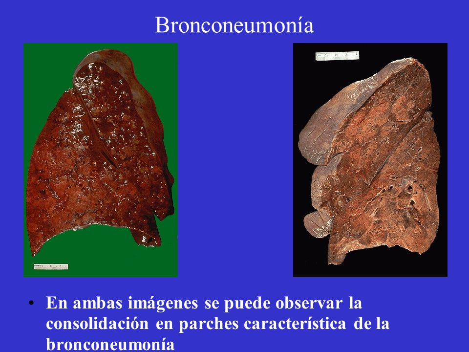Bronconeumonía En ambas imágenes se puede observar la consolidación en parches característica de la bronconeumonía.