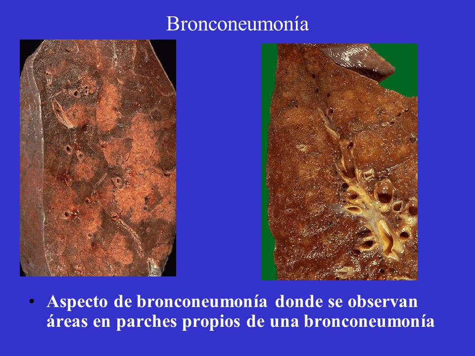 Bronconeumonía Aspecto de bronconeumonía donde se observan áreas en parches propios de una bronconeumonía.