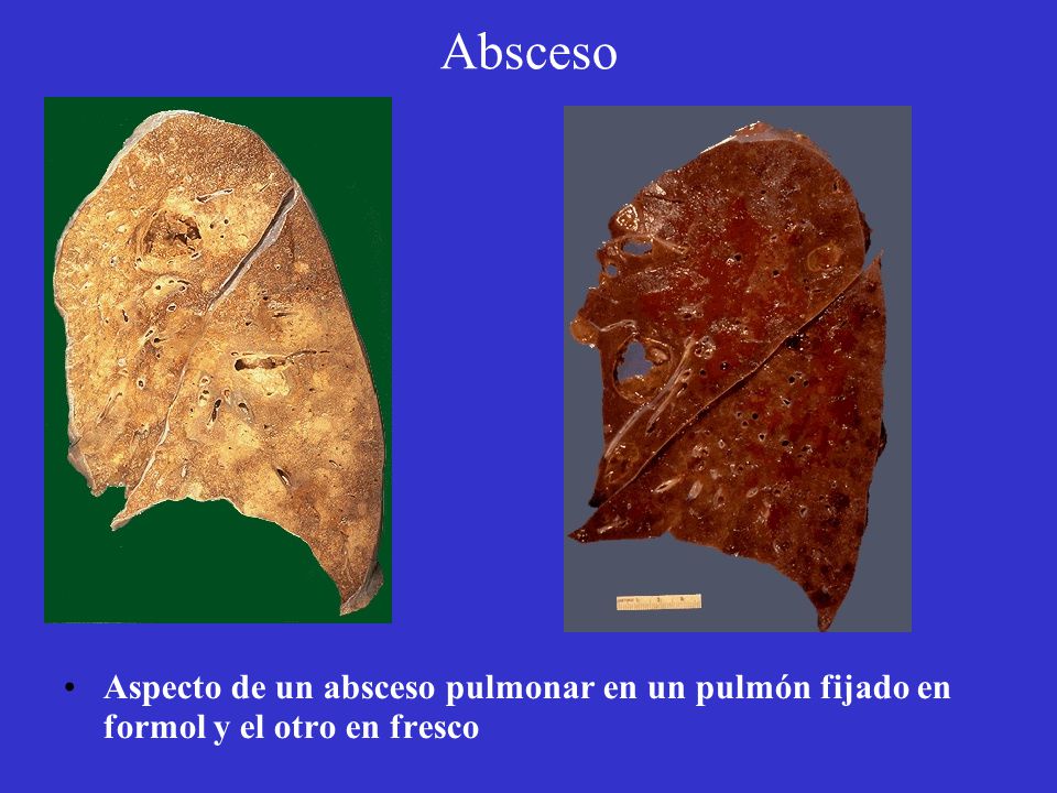 Absceso Aspecto de un absceso pulmonar en un pulmón fijado en formol y el otro en fresco