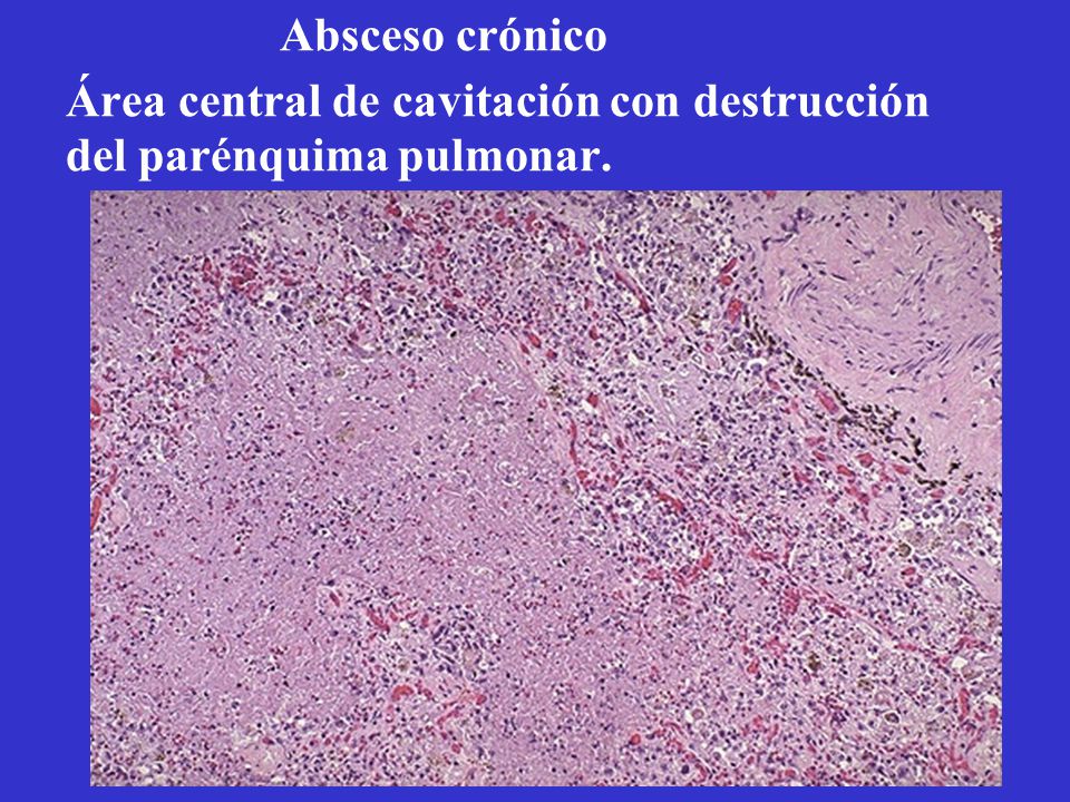 Absceso crónico Área central de cavitación con destrucción del parénquima pulmonar.