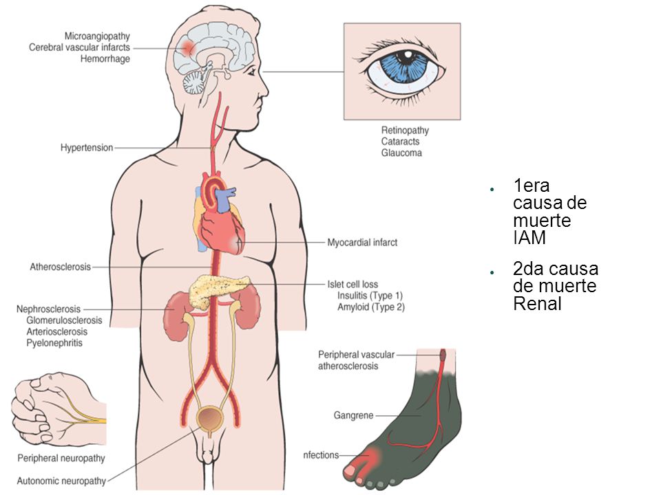 1era causa de muerte IAM 2da causa de muerte Renal