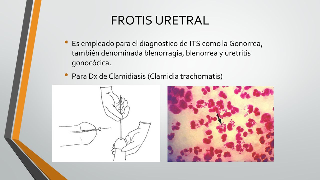 FROTIS URETRAL Es empleado para el diagnostico de ITS como la Gonorrea, también denominada blenorragia, blenorrea y uretritis gonocócica.