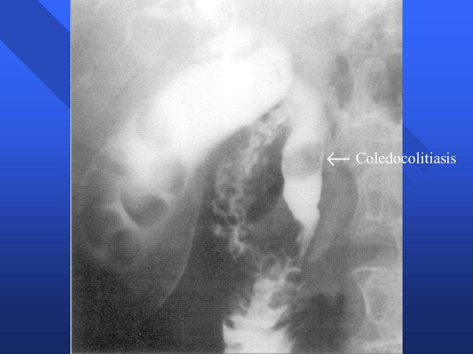 Coledocolitiasis