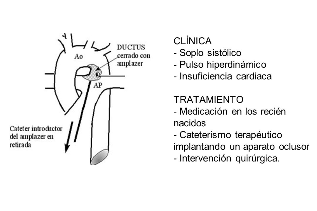 CLÍNICA - Soplo sistólico - Pulso hiperdinámico - Insuficiencia cardiaca TRATAMIENTO - Medicación en los recién nacidos - Cateterismo terapéutico implantando un aparato oclusor - Intervención quirúrgica.