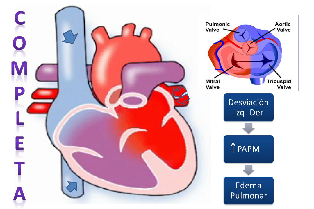 C O. M. P. L. E. T. a. Desviación Izq -Der. PAPM. Edema Pulmonar.