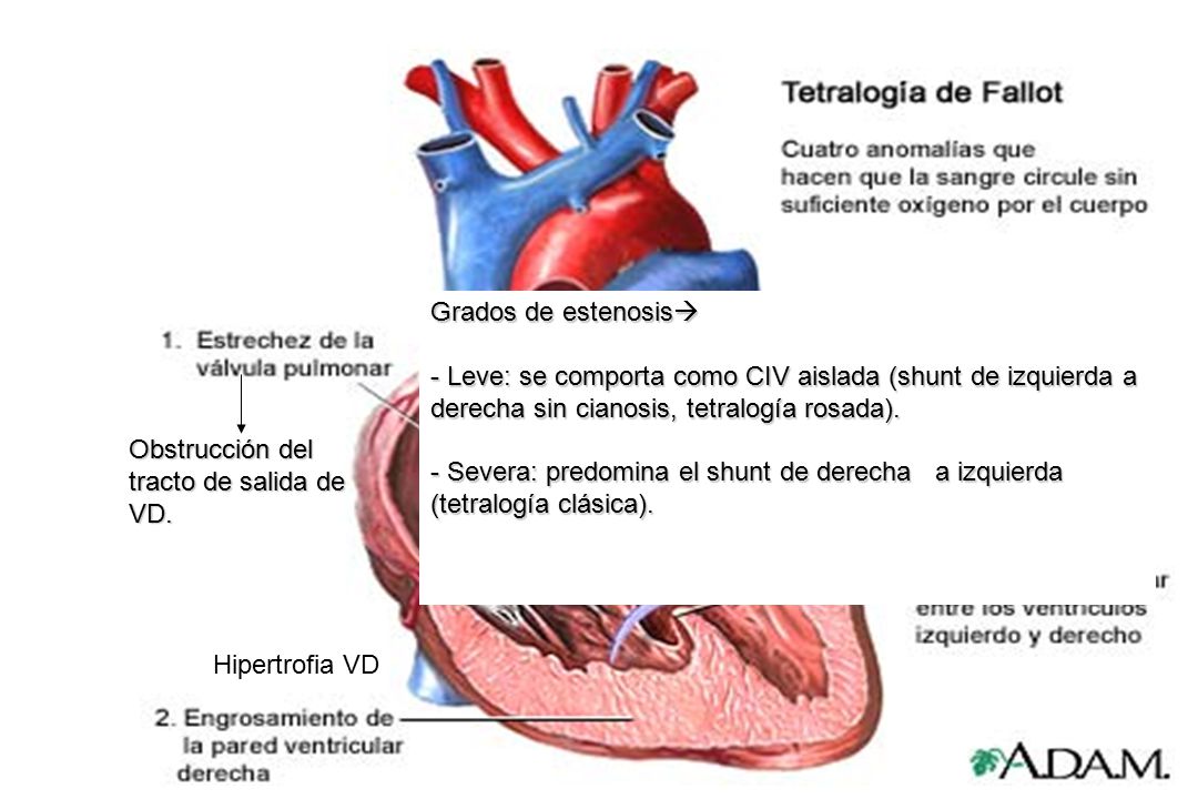 Grados de estenosis - Leve: se comporta como CIV aislada (shunt de izquierda a derecha sin cianosis, tetralogía rosada).