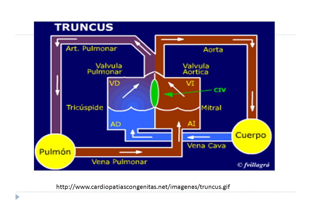 TA es benigna durante el desarrollo intrauterino del feto, con mínimas alteraciones en la fisio-logía cardiovascular fetal. Sin embargo, la naturaleza benigna del TA cambia de forma dramática después del nacimien-to, con la caída de las resistencias pul-monares, apareciendo una severa insufi-ciencia cardiaca congestiva, responsable de la extremada alta mortalidad durante el primer año de vida de estos pacientes.