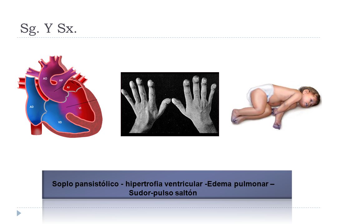 Sg. Y Sx. Rara vez, se necesita una cateterización del corazón para ayudar en el diagnóstico o planear una estrategia de tratamiento.
