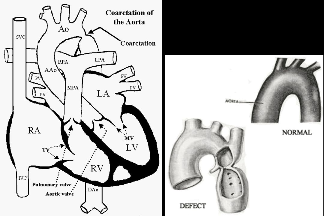 Coartación de la Aorta Tipo Adulto