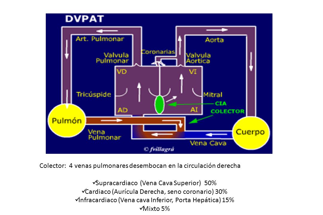 Colector: 4 venas pulmonares desembocan en la circulación derecha