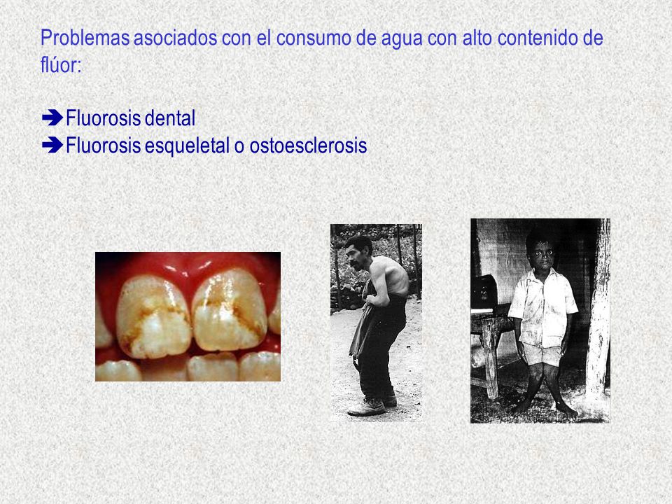 Problemas asociados con el consumo de agua con alto contenido de flúor: