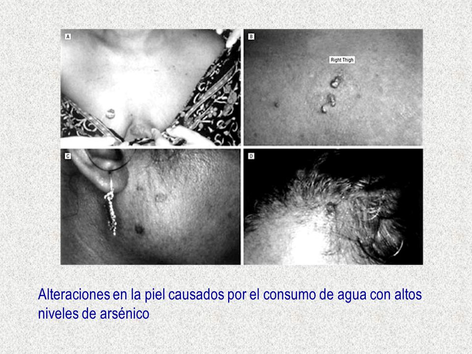 Alteraciones en la piel causados por el consumo de agua con altos niveles de arsénico