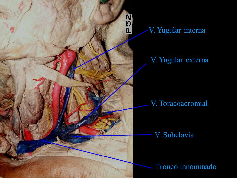 V. Yugular interna V. Yugular externa V. Toracoacromial V. Subclavia Tronco innominado