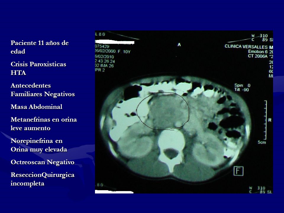 Paciente 11 años de edad Crisis Paroxisticas HTA. Antecedentes Familiares Negativos. Masa Abdominal.