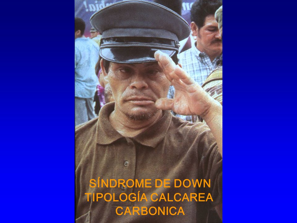 SÍNDROME DE DOWN TIPOLOGÍA CALCAREA CARBONICA