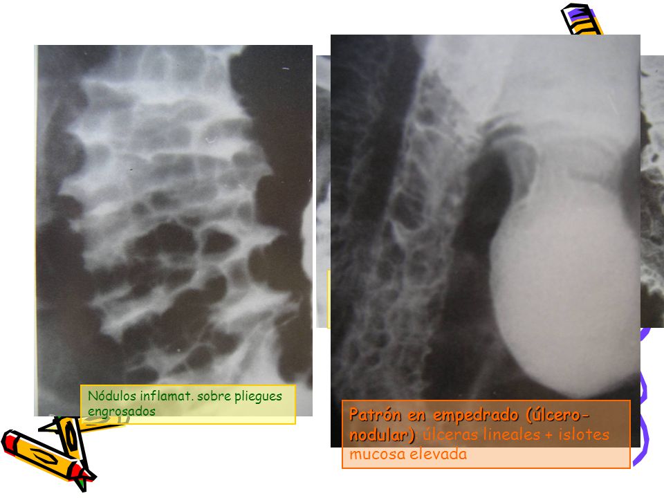 Patrón nodular: nódulos inflamat +líneas curvas de bario entre ellos (no úlceras). Bordes nodulares
