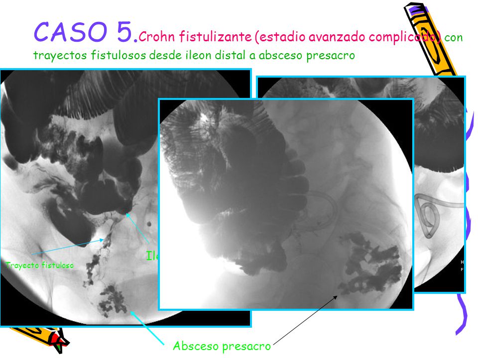 CASO 5.Crohn fistulizante (estadio avanzado complicado) con trayectos fistulosos desde ileon distal a absceso presacro