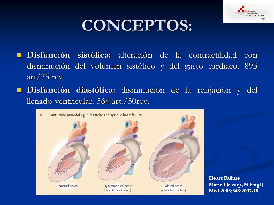 CONCEPTOS: Disfunción sistólica: alteración de la contractilidad con disminución del volumen sistólico y del gasto cardiaco. 893 art/75 rev.
