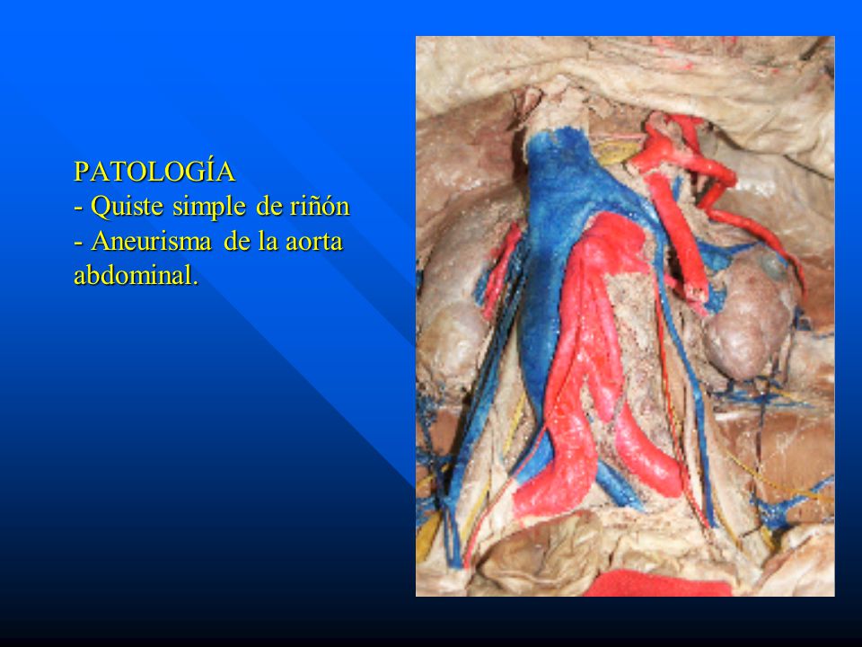 PATOLOGÍA - Quiste simple de riñón - Aneurisma de la aorta abdominal.