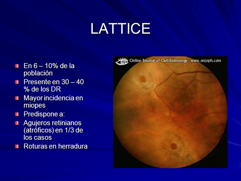 LATTICE En 6 – 10% de la población Presente en 30 – 40 % de los DR