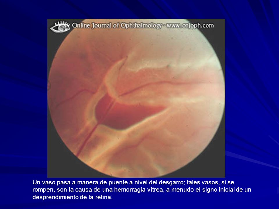 Un vaso pasa a manera de puente a nivel del desgarro; tales vasos, si se rompen, son la causa de una hemorragia vítrea, a menudo el signo inicial de un desprendimiento de la retina.