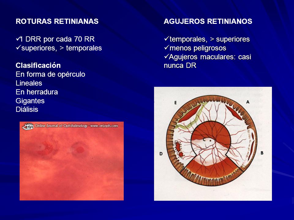 ROTURAS RETINIANAS 1 DRR por cada 70 RR. superiores, > temporales. Clasificación. En forma de opérculo.