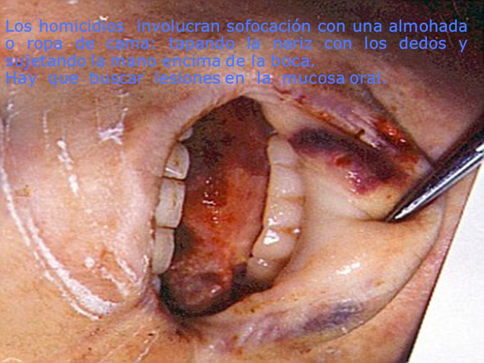 Los homicidios involucran sofocación con una almohada o ropa de cama: tapando la nariz con los dedos y sujetando la mano encima de la boca.