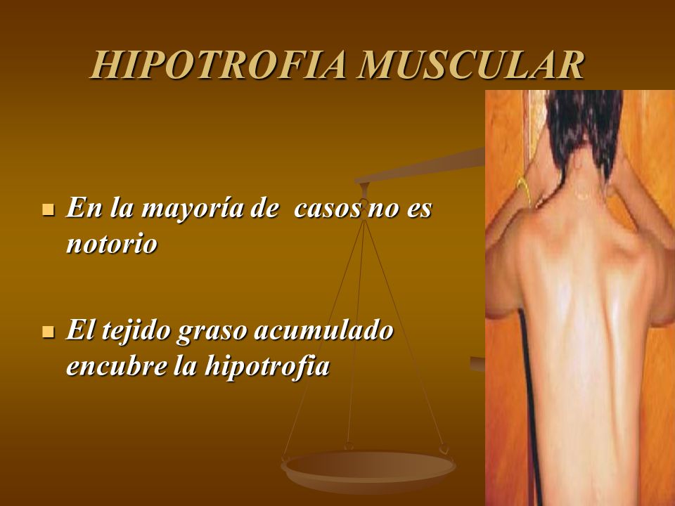 HIPOTROFIA MUSCULAR En la mayoría de casos no es notorio