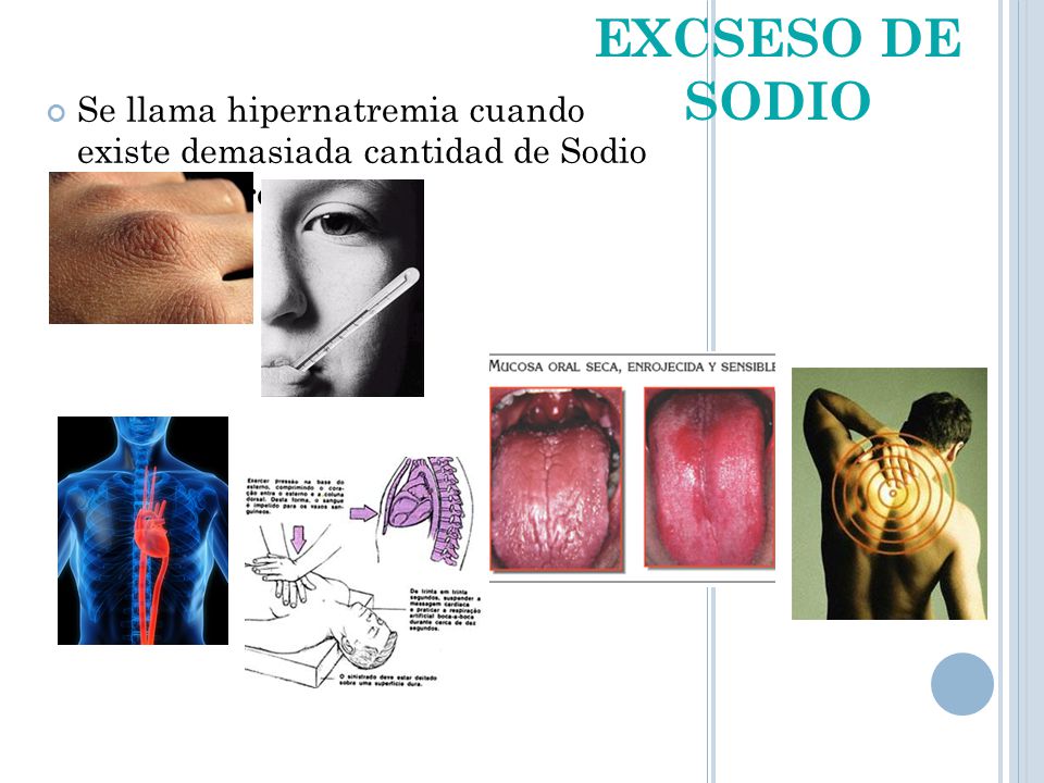 EXCSESO DE SODIO Se llama hipernatremia cuando existe demasiada cantidad de Sodio en la sangre.