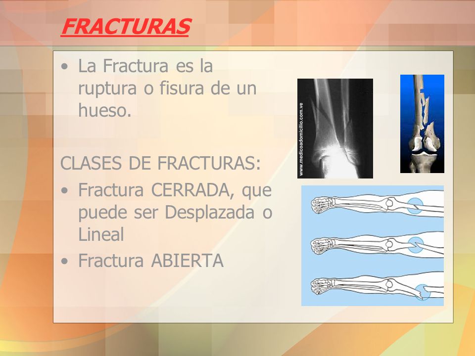 FRACTURAS La Fractura es la ruptura o fisura de un hueso.