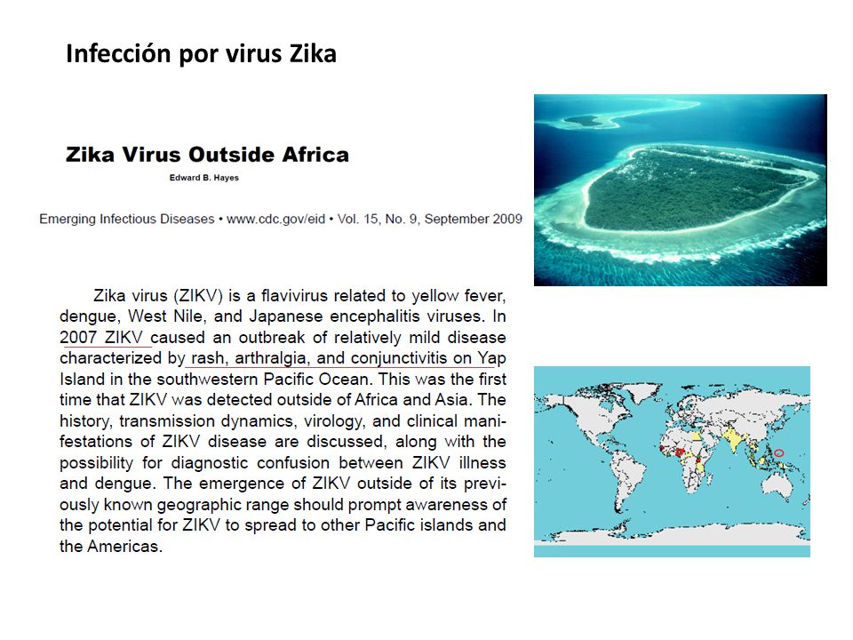 Infección por virus Zika