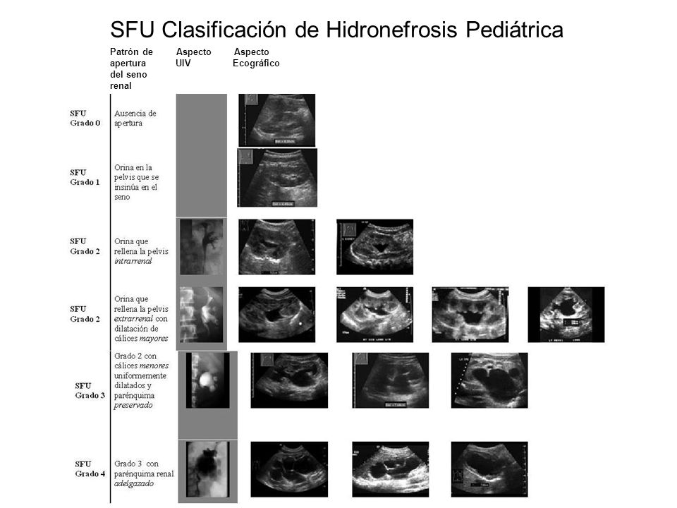 SFU Clasificación de Hidronefrosis Pediátrica Patrón de Aspecto Aspecto apertura UIV Ecográfico del seno renal