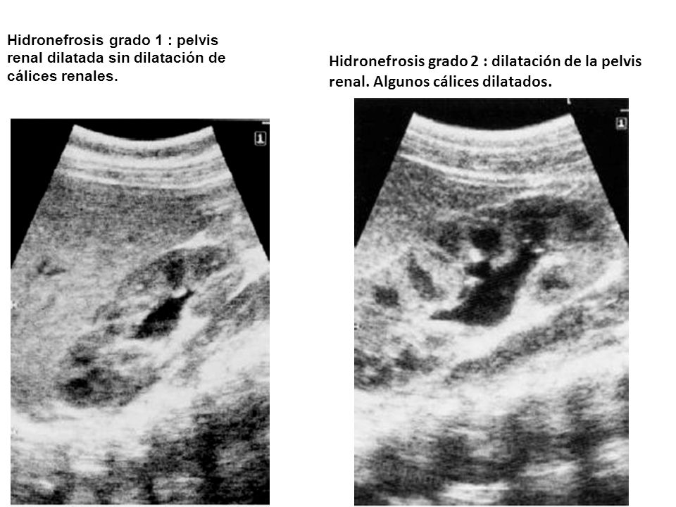 Hidronefrosis grado 1 : pelvis renal dilatada sin dilatación de cálices renales.