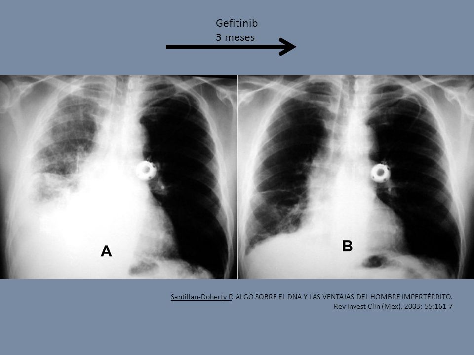 Gefitinib 3 meses. Santillan-Doherty P. ALGO SOBRE EL DNA Y LAS VENTAJAS DEL HOMBRE IMPERTÉRRITO.