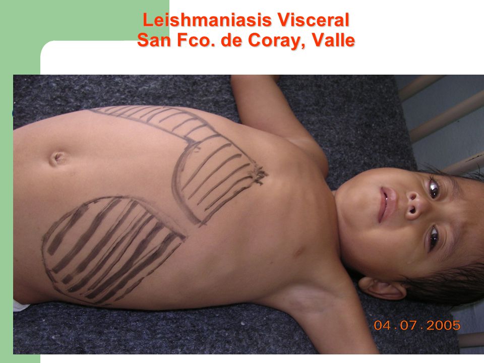Leishmaniasis Visceral San Fco. de Coray, Valle