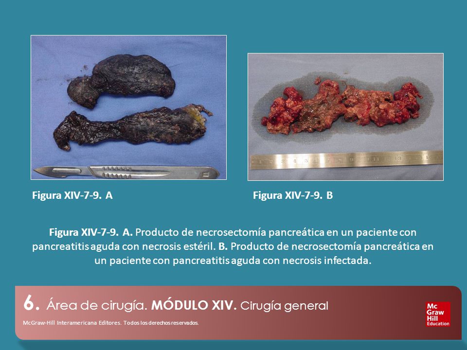 Figura XIV-7-9. A Figura XIV-7-9. B.