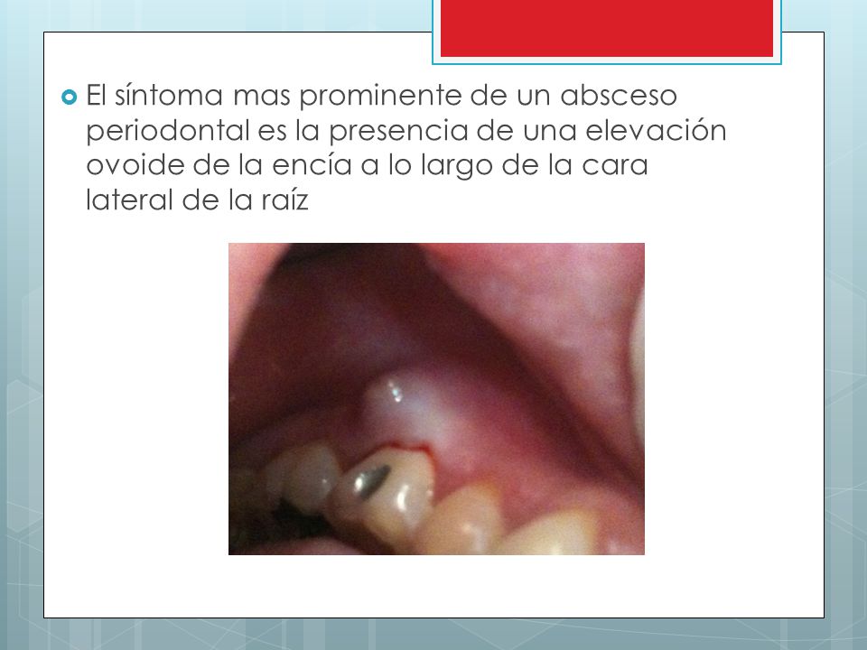 El síntoma mas prominente de un absceso periodontal es la presencia de una elevación ovoide de la encía a lo largo de la cara lateral de la raíz