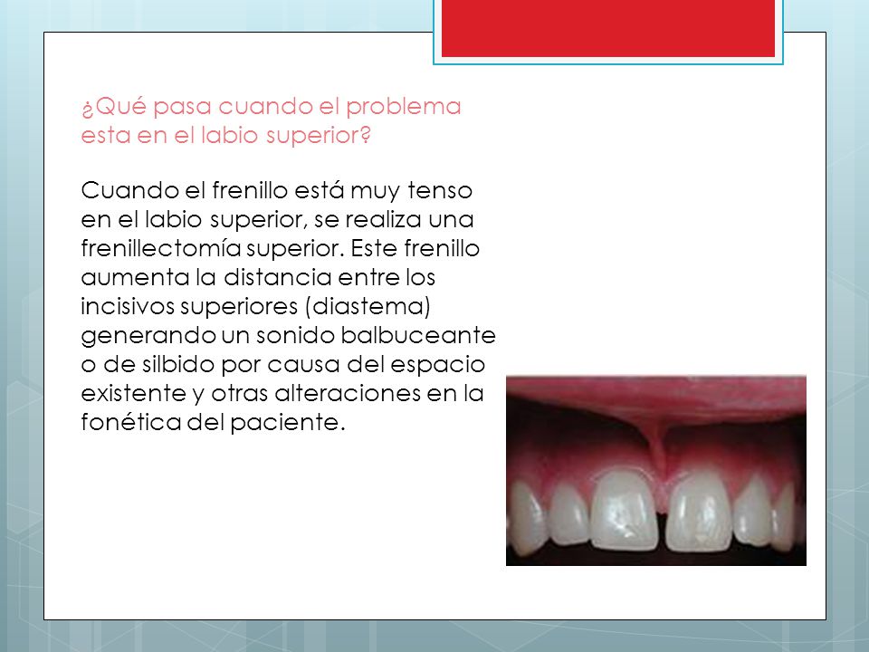 ¿Qué pasa cuando el problema esta en el labio superior