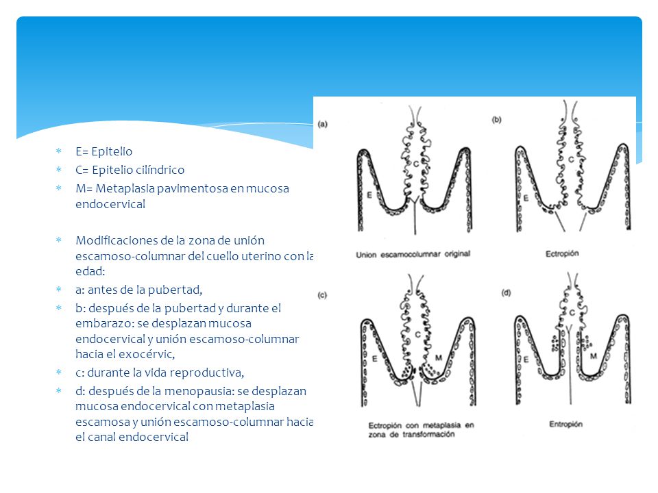 E= Epitelio C= Epitelio cilíndrico. M= Metaplasia pavimentosa en mucosa endocervical.