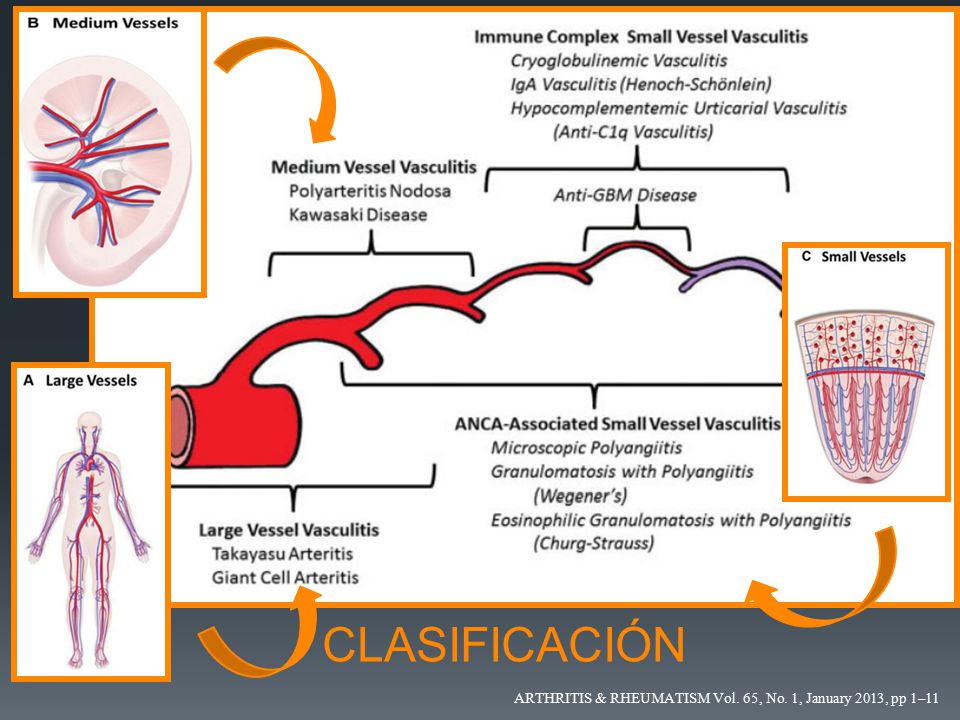 Las vasculitis pulmonares se clasifican de acuerdo al tamaño del vaso afectado predominantemente, Pero es importante saber que pueden afectar a distintos calibes a la vez.