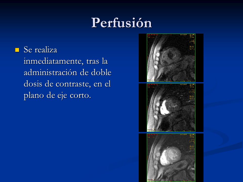 Perfusión Se realiza inmediatamente, tras la administración de doble dosis de contraste, en el plano de eje corto.