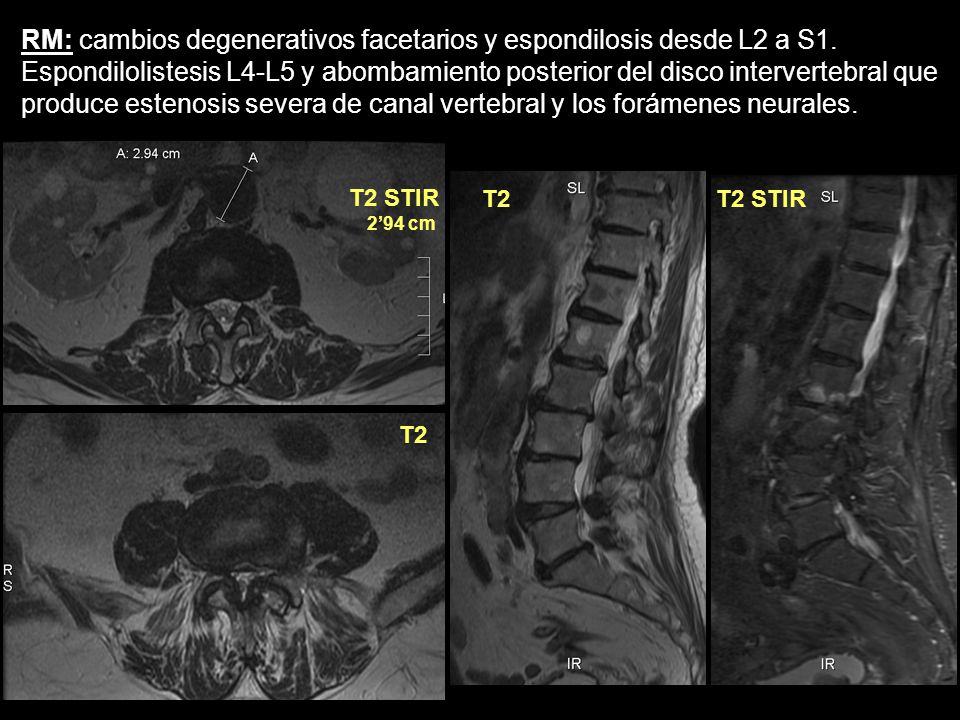 RM: cambios degenerativos facetarios y espondilosis desde L2 a S1.